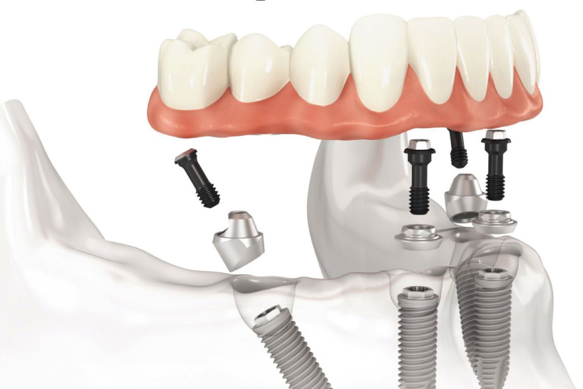 Doctor Q, רשת מרפאות שיניים, יישור שיניים, שיחזור שיניים