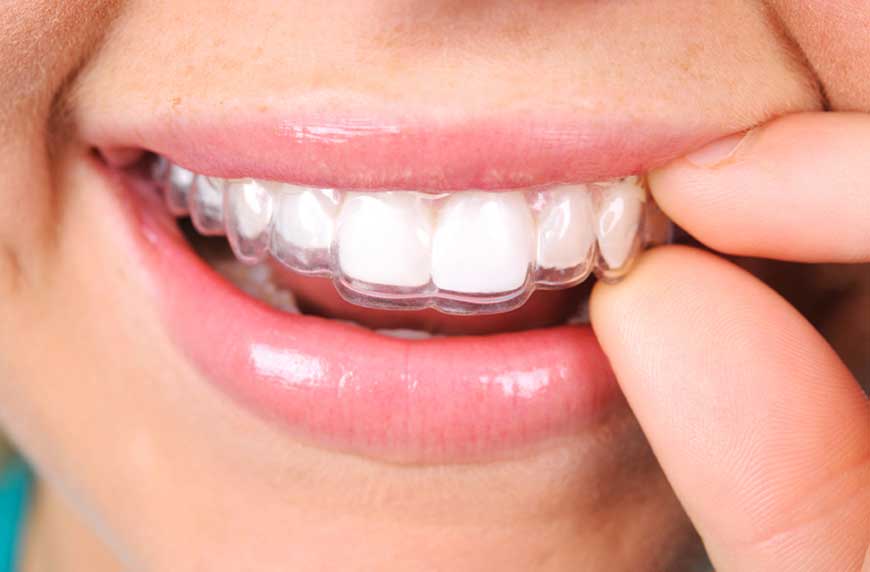 יישור שיניים ובריאות הפה